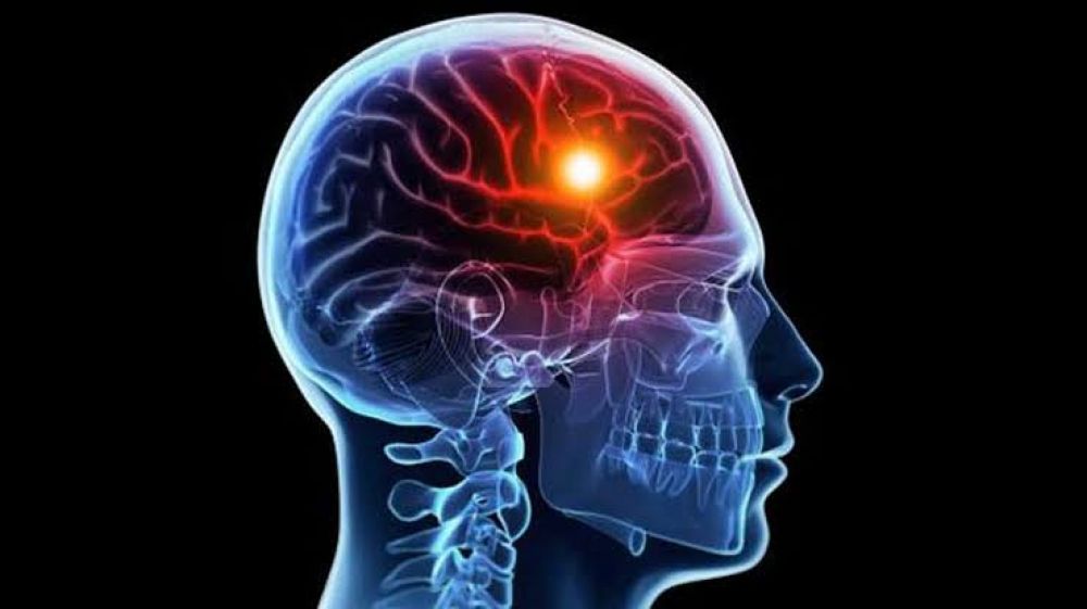 Apa Itu Head Stroke? Kenali Tanda-Tandanya