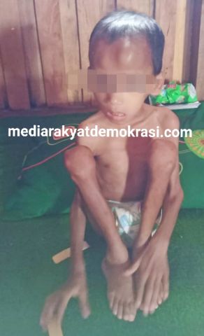 Gerak Cepat Dinkes Tuba, Tangani Anak Penderita Gizi Buruk